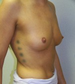 Breast Augmentation