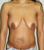 Breast Augmentation