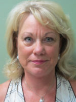 Facelift