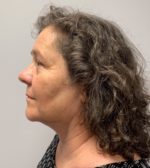 Submental (Chin) Liposuction