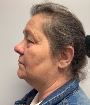 Submental (Chin) Liposuction