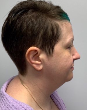 Submental (Chin) Liposuction