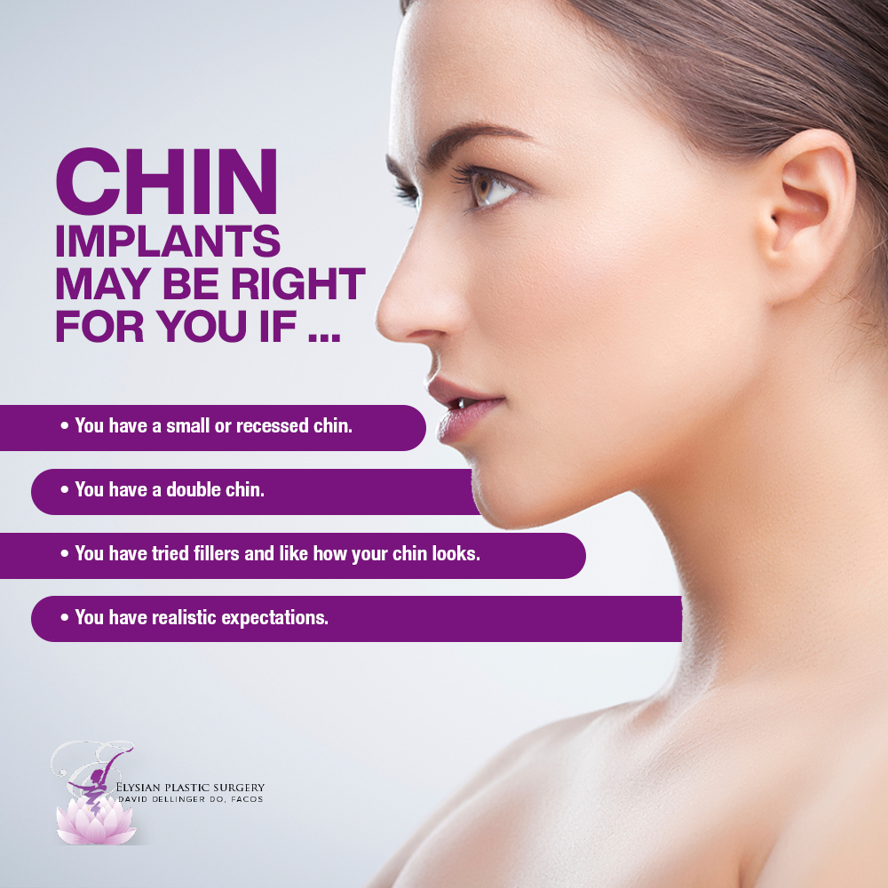 Chin Implant Infographic - Dellinger - Jan 2022